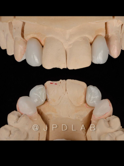 Resin Bonded Prosthetic